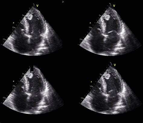 left ventricular thrombus after infarction